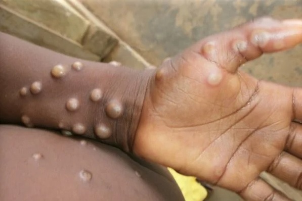  Ministério da Saúde diz que Brasil está preparado para enfrentar surto de monkeypox.